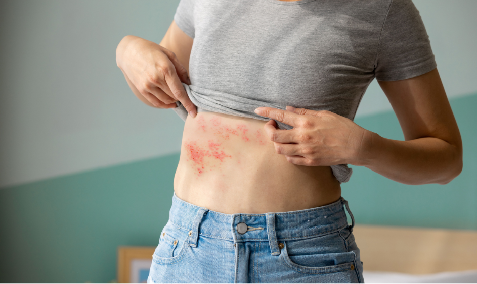 Półpasiec szczepienia